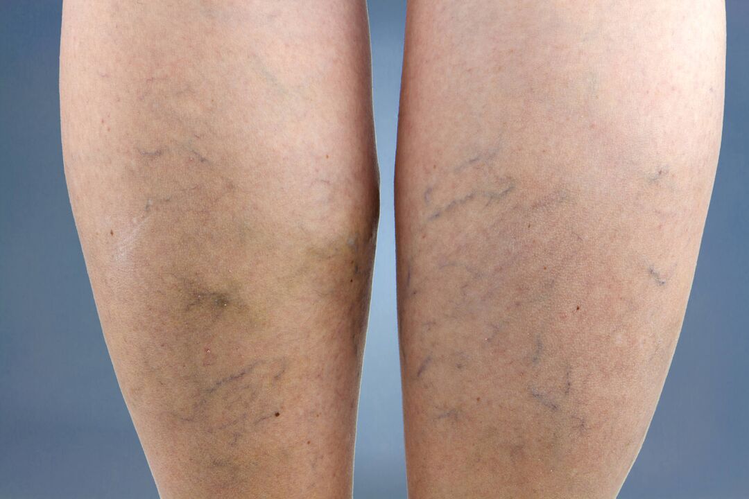 varicose veins on the legs