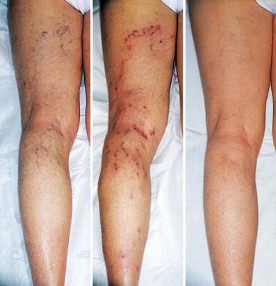 Lower limbs before and after varicose vein treatment