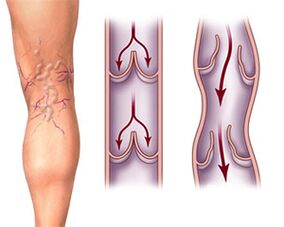 Normal valve function in a healthy vein and valve pathology in a varicose vein. 