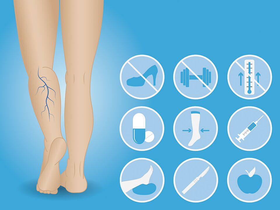 Varicose veins of the lower extremities. 