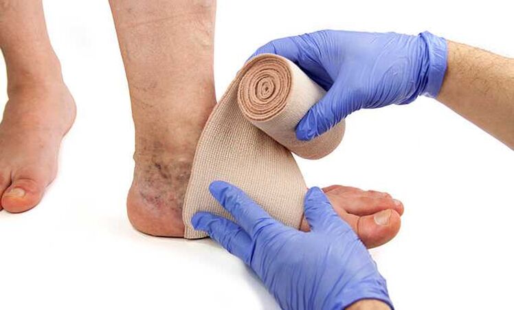 The treatment of varicose veins in the legs is complemented by the use of compression stockings. 