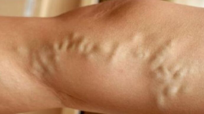 Varicose veins