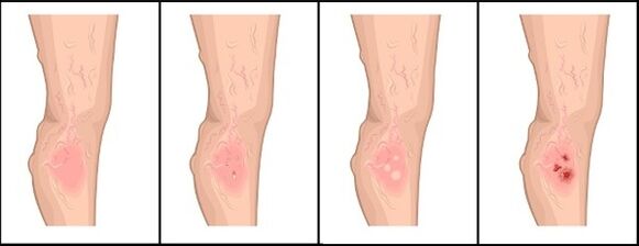 The degree of varicose veins
