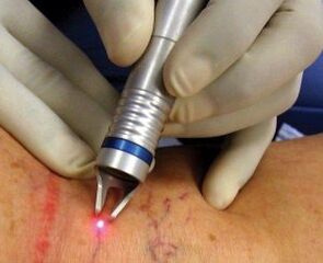 How to carry out laser treatment of varicose veins