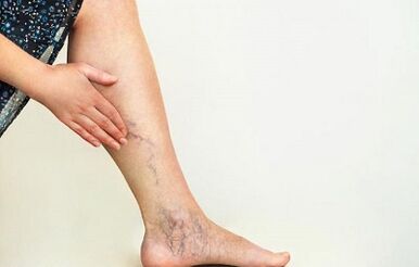 How to treat varicose veins of the lower extremities.