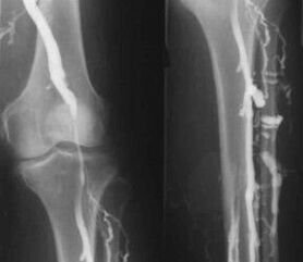 Diagnostic options for varicose veins of the extremities.