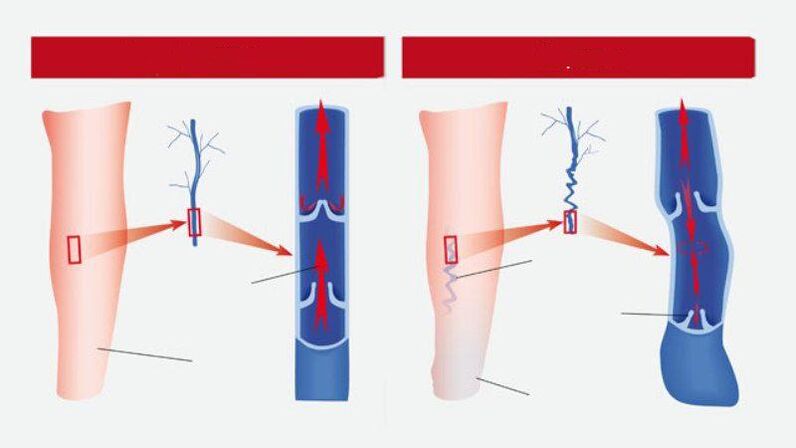 How do you see varicose veins